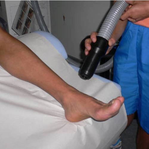 Zabieg krioterapii miejscowej zimnym powietrzem Cryo 6 na stopie pacjenta.